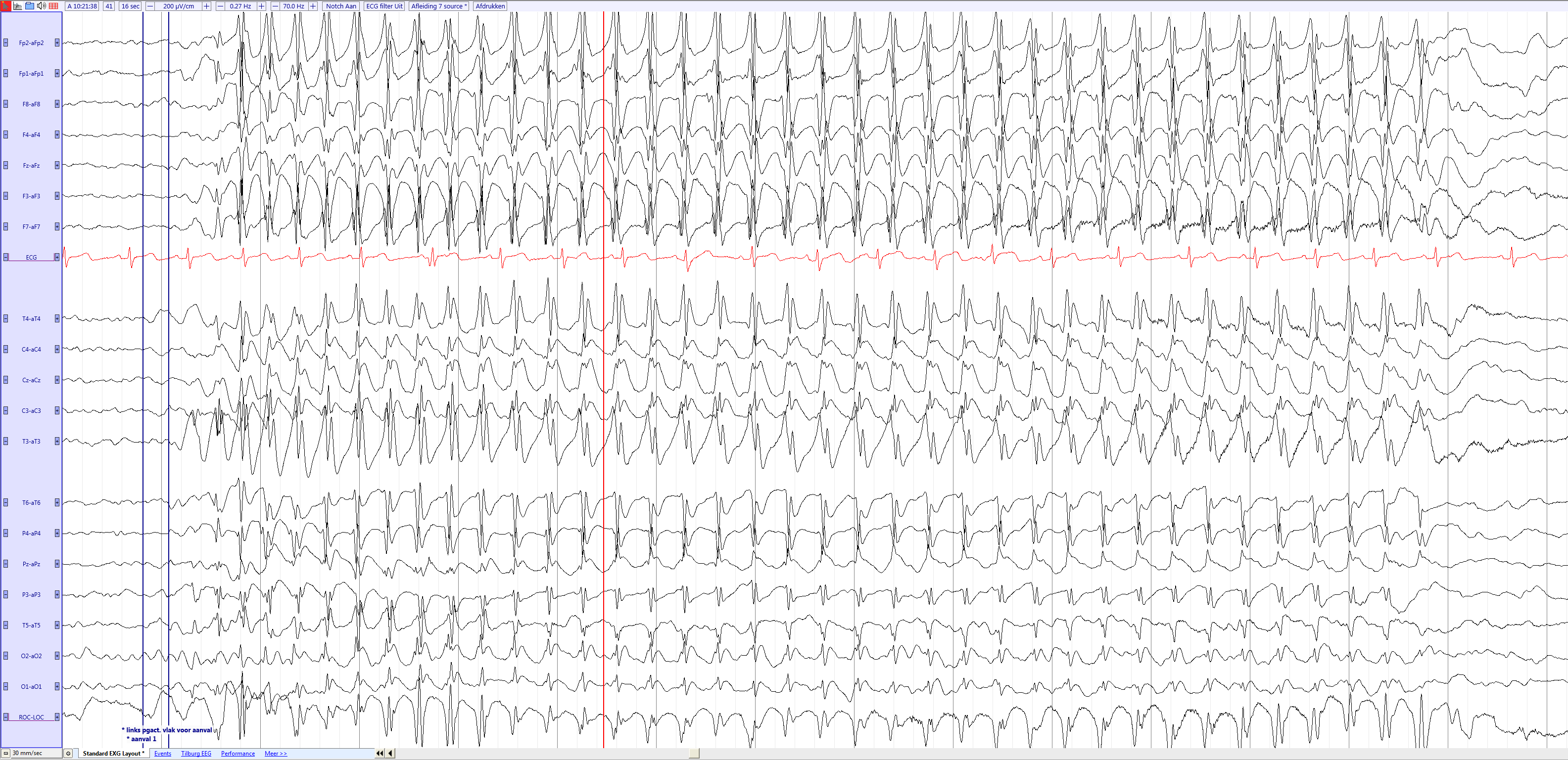 file-childhood-absence-epilepsy-4-5-year-old-girl-source-eegpedia-png