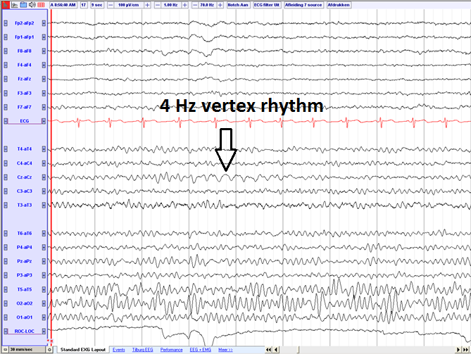 4 Hz vertex rhythm (source) eegpedia.png