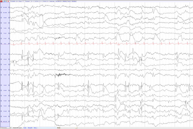 File:Lennox gastaut in a 3 years and 10 months old boy (source) EEGpedia.png