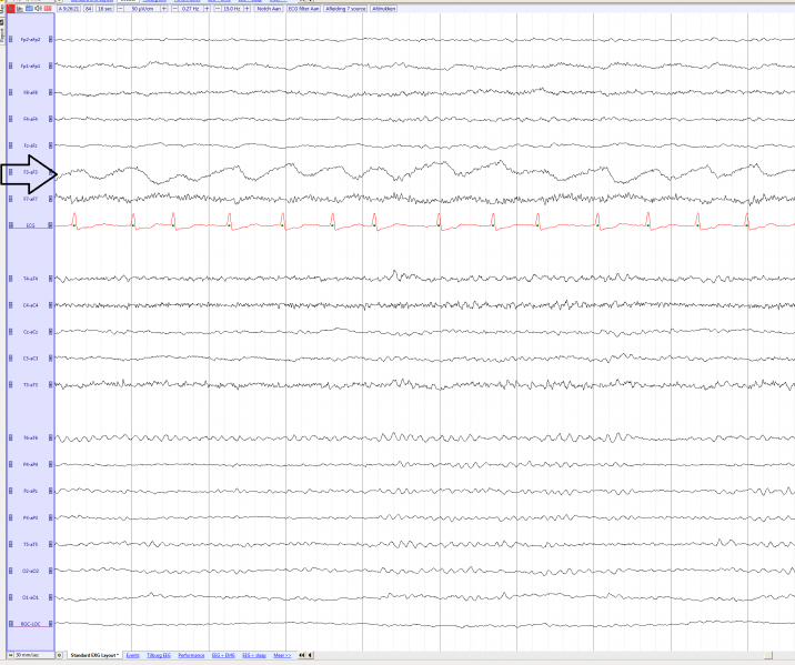 File:Pulse artifact (source) EEGpedia.png