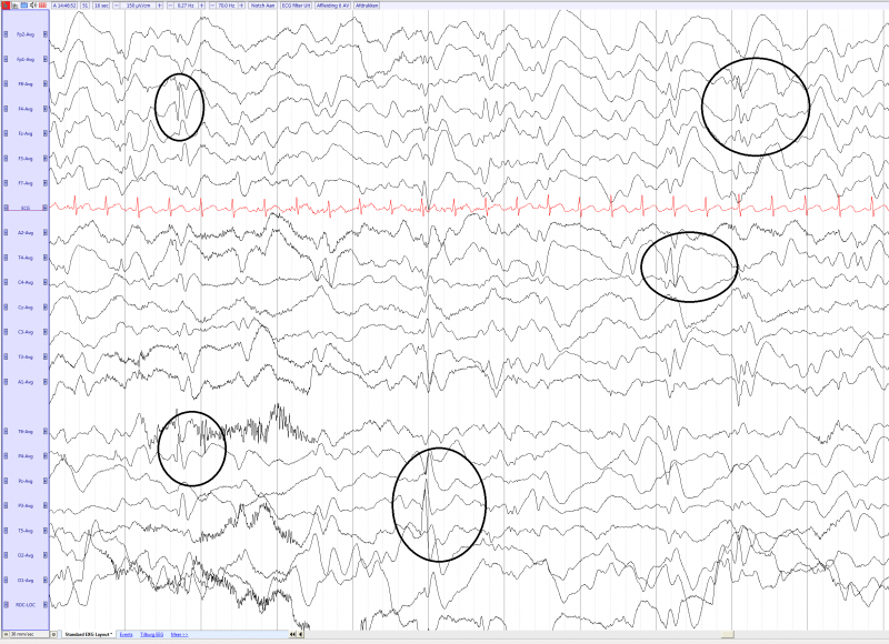 File:West syndrome with hypsarrhytmia in a 8 months old girl (average) EEGpedia.png