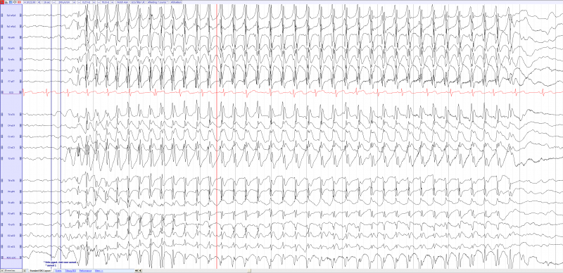File:Childhood absence epilepsy 4,5 year old girl (source) EEGpedia.png