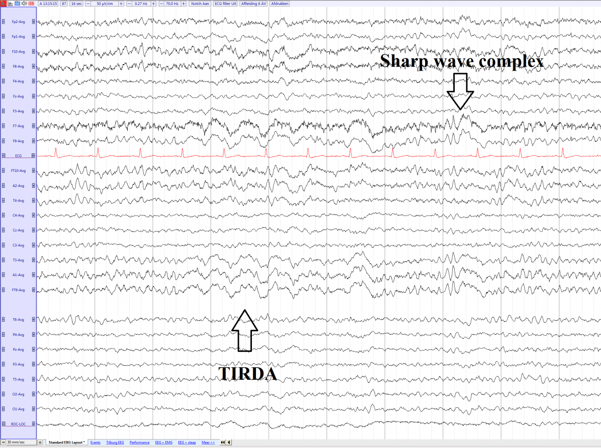 TIRDA in a 72 year old female with left temporal epilepsy (average) EEGpedia.png