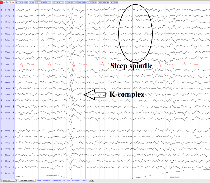 File:K-complex (average) eegpedia.png