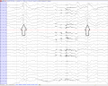 Spike slow wave complex in a boy 12 years old (average).png