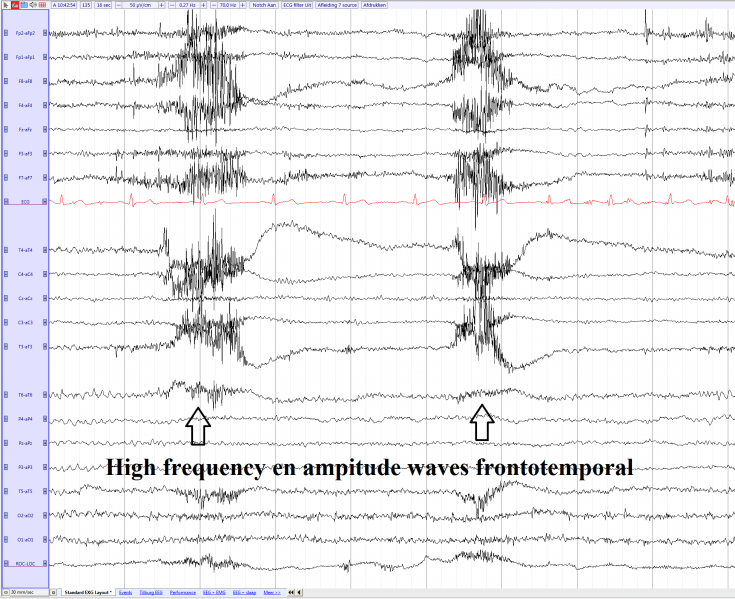 File:Muscle artifacts during chewing.png