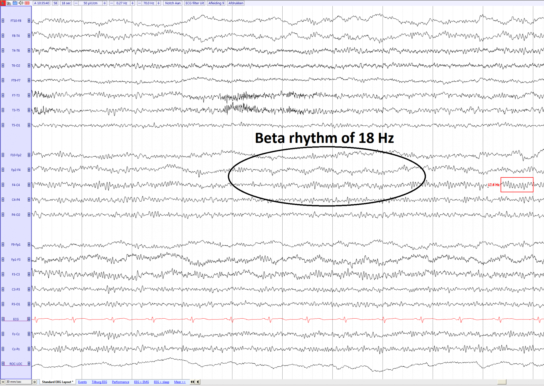 Beta rhythm EEGpedia