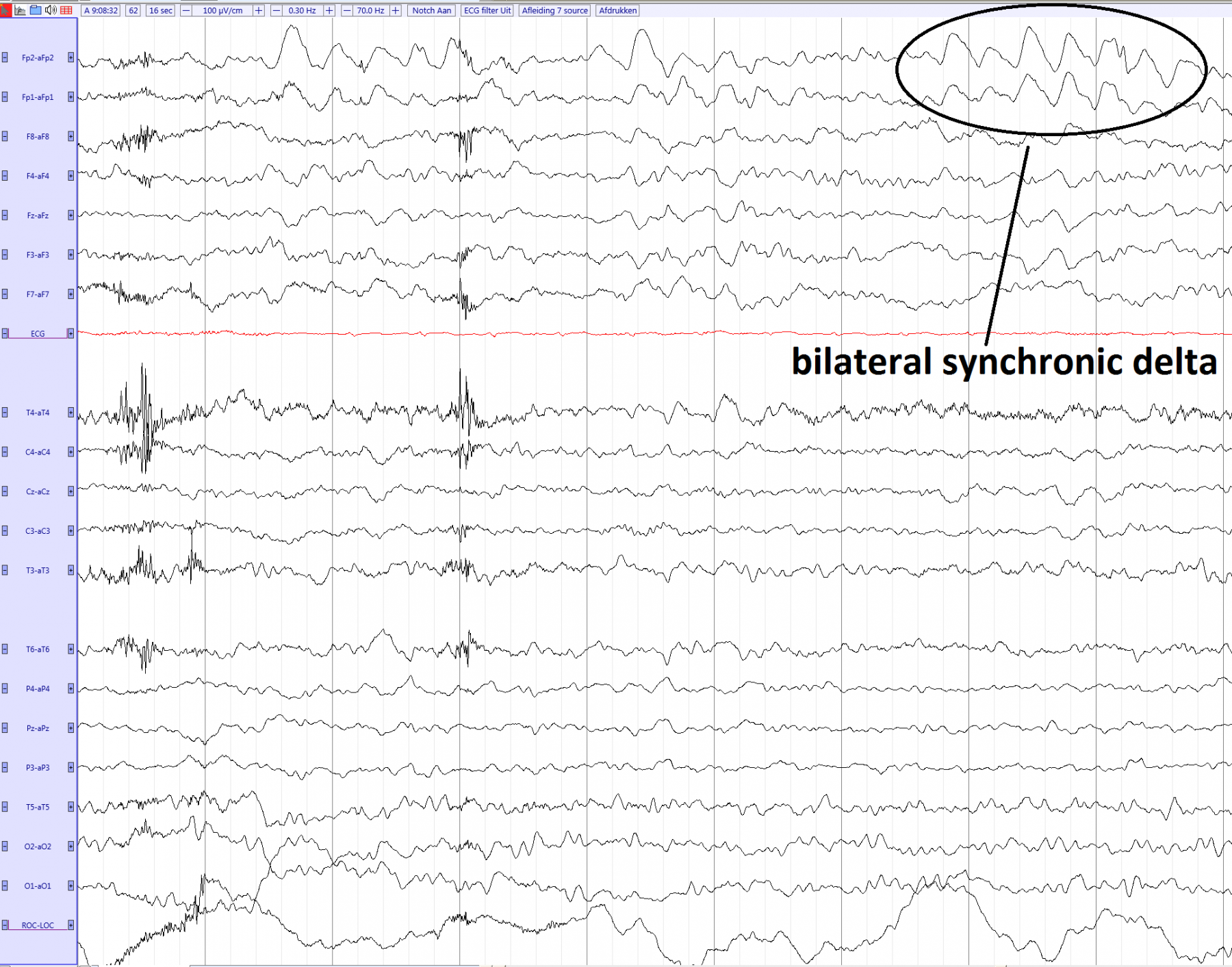 Normal slowing during hyperventilation EEGpedia