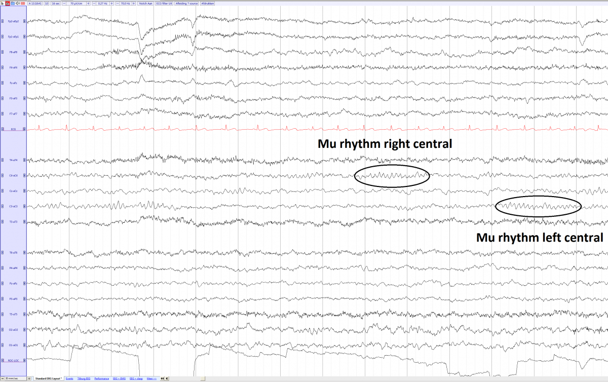 Mu 5 year old left en right frequency 9,8 e.png