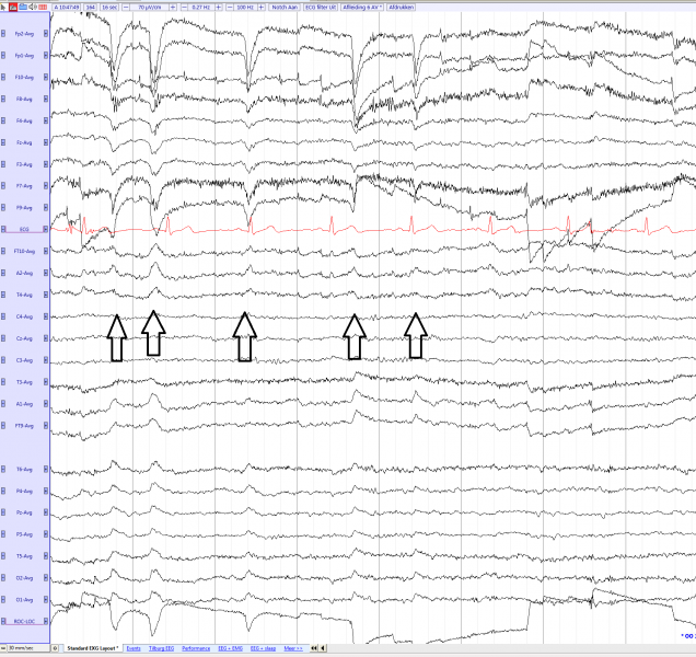 File:Blink artifacts (average) eegpedia.png