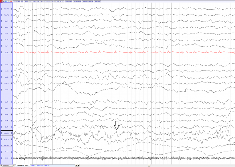 File:Panayiotopoulos Syndrome in a 5 year old girl (source) EEGpedia.png