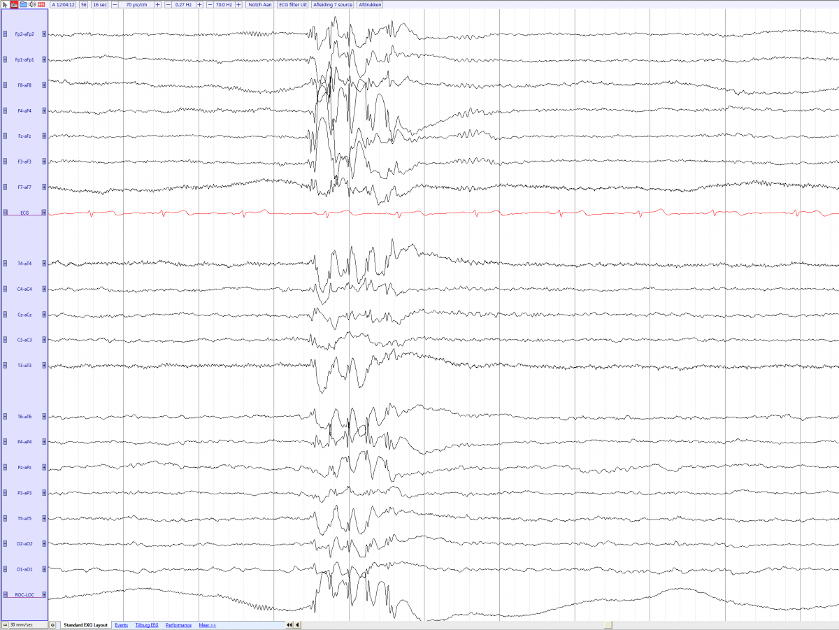 Juvenile myoclonic epilepsy in a 15 year old male (source) EEGpedia.png