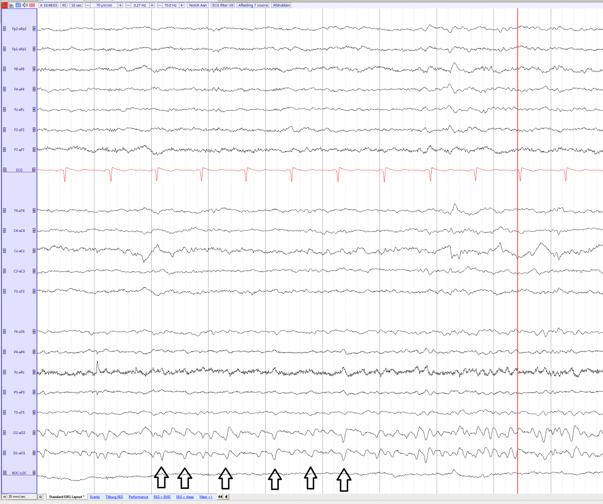 POSTS en vertexwave (source) eegpedia.png