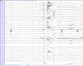 Rolandic epilepsy in a 7 year old girl (average) EEGpedia.png