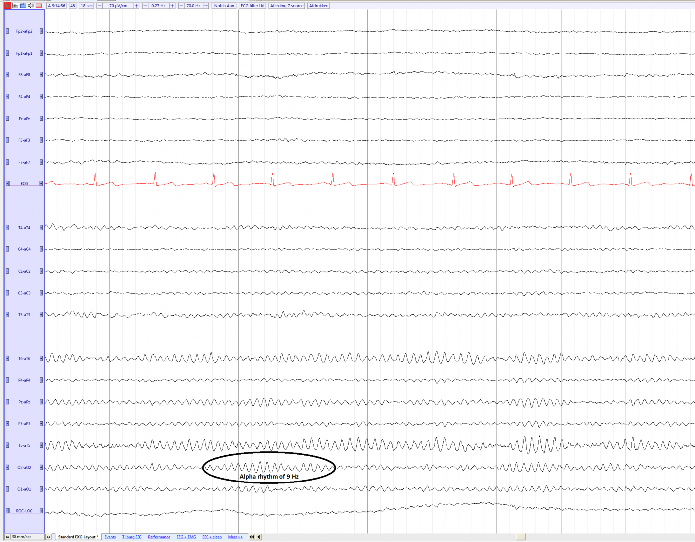 Alpha rhythm average e.png