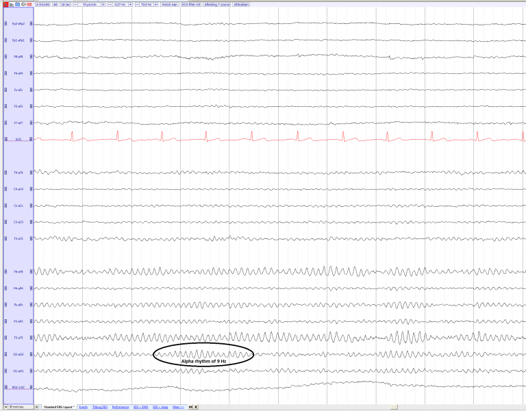 File:Alpha rhythm average e.png